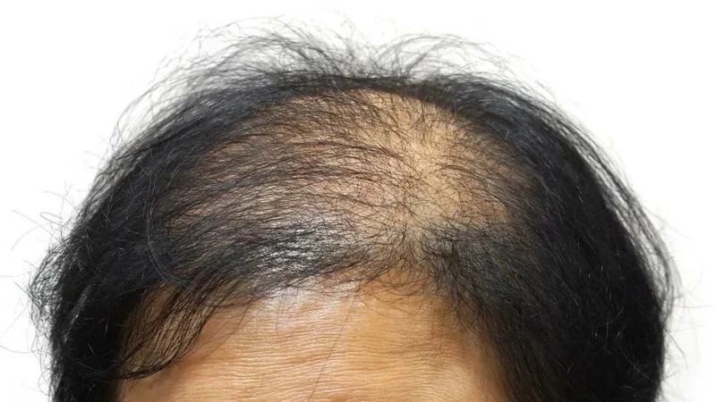 alopecia androgenica